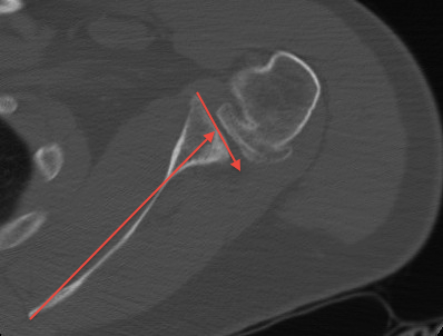 Glenoid Retroversion SPSS